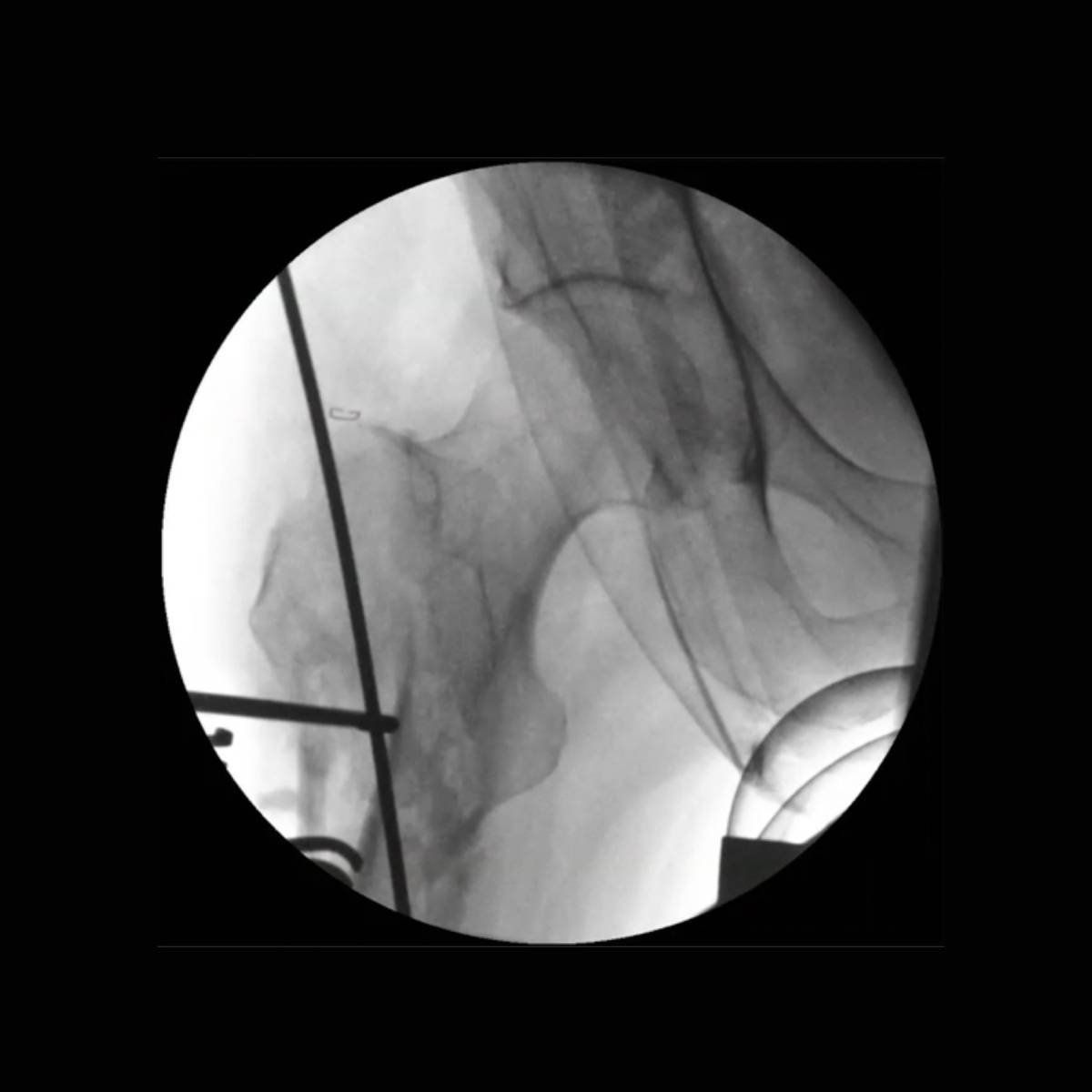 Treatment of Long Bone Nonunion: The Role of the Diamond Concept